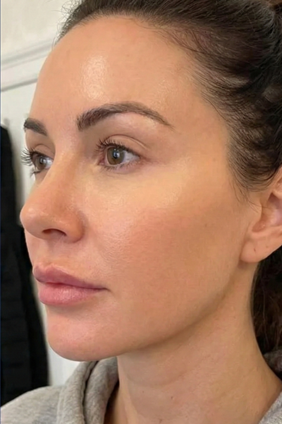 8 weeks after 2 sessions of Cutera Secret PRO CO2 laser resurfacing, significant improvement in acne scarring, skin texture and firmness, The Regenerative Aesthetics London
