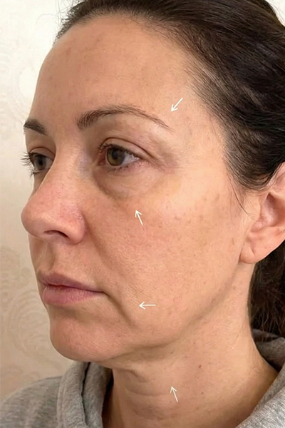 Before CO2 laser resurfacing, female patient, 43, with deep acne scarring, uneven skin texture and loss of firmness, The Regenerative Aesthetics London